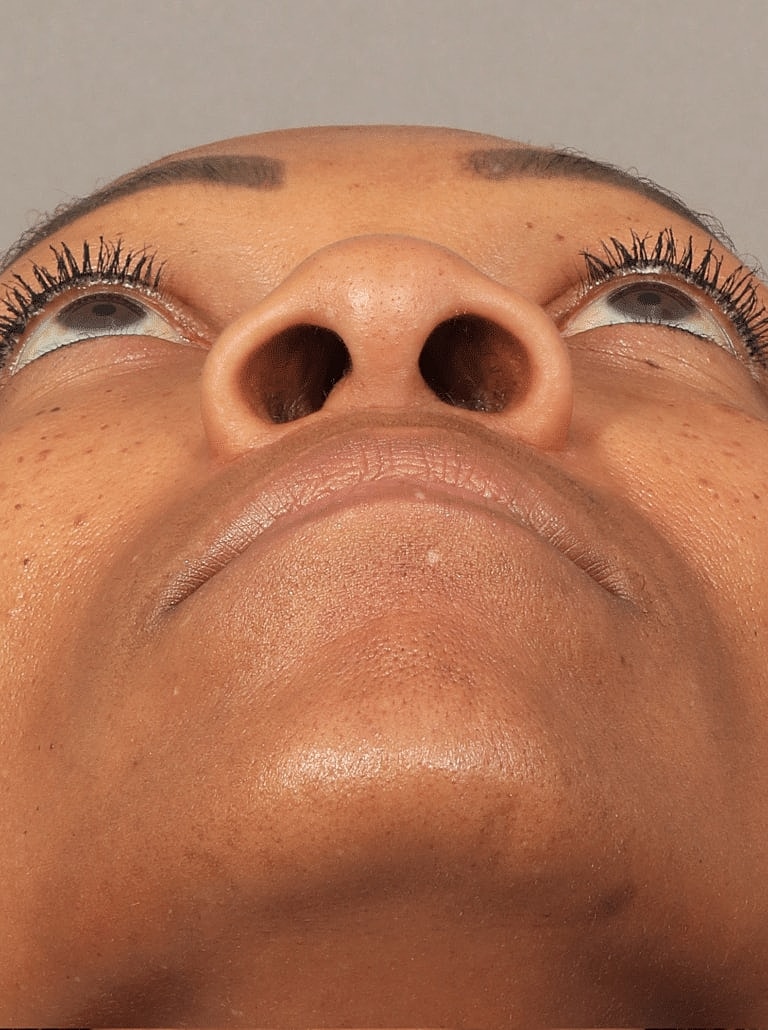 Nose Job Rhinoplasty Before & After