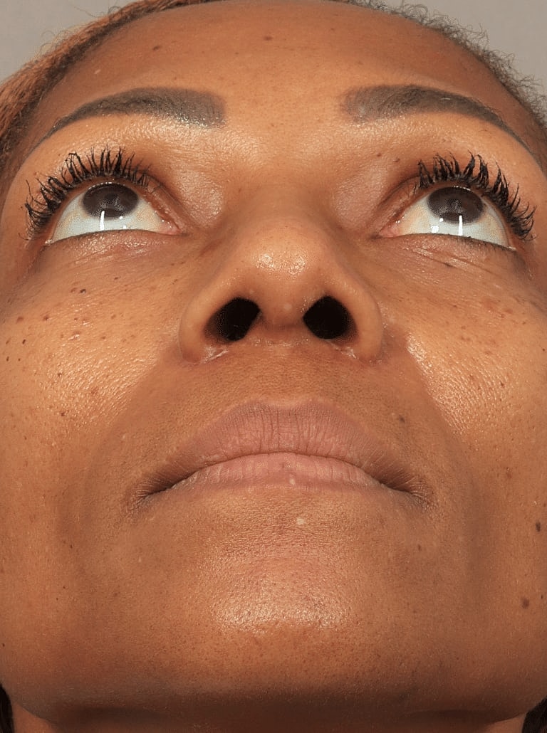 Nose Job Rhinoplasty Before & After