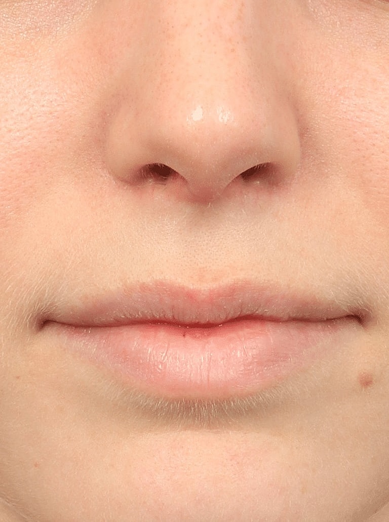 Nose Job Rhinoplasty Before & After
