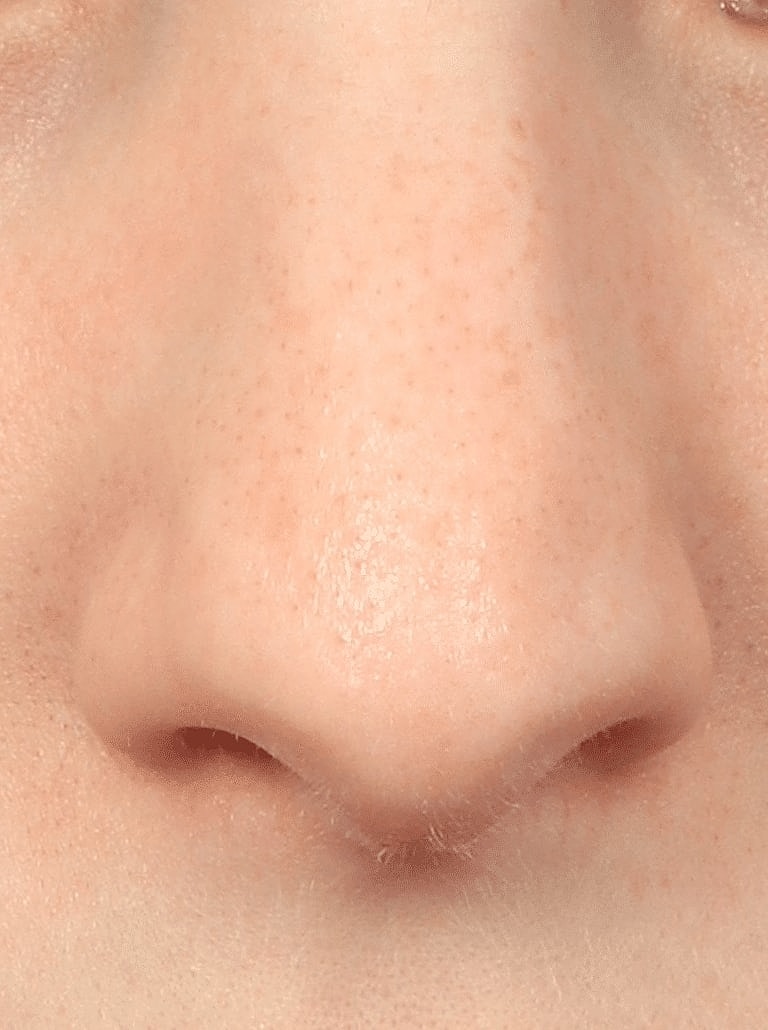 Nose Job Rhinoplasty Before & After
