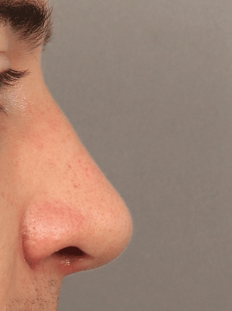 Nose Job Rhinoplasty Before & After