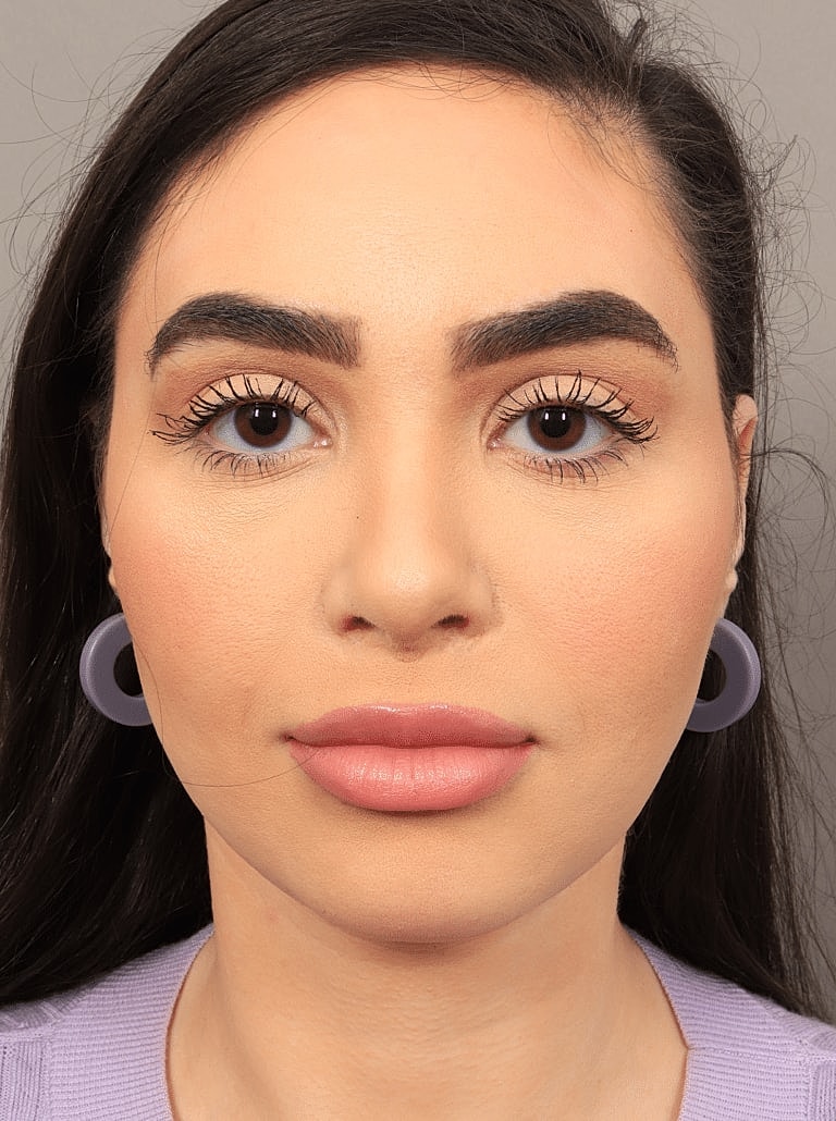 Nose Job Rhinoplasty Before & After