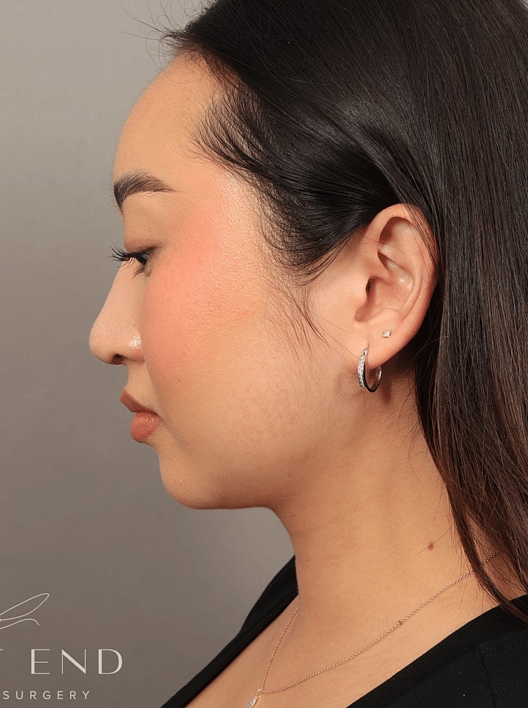 Nose Job Rhinoplasty Before & After