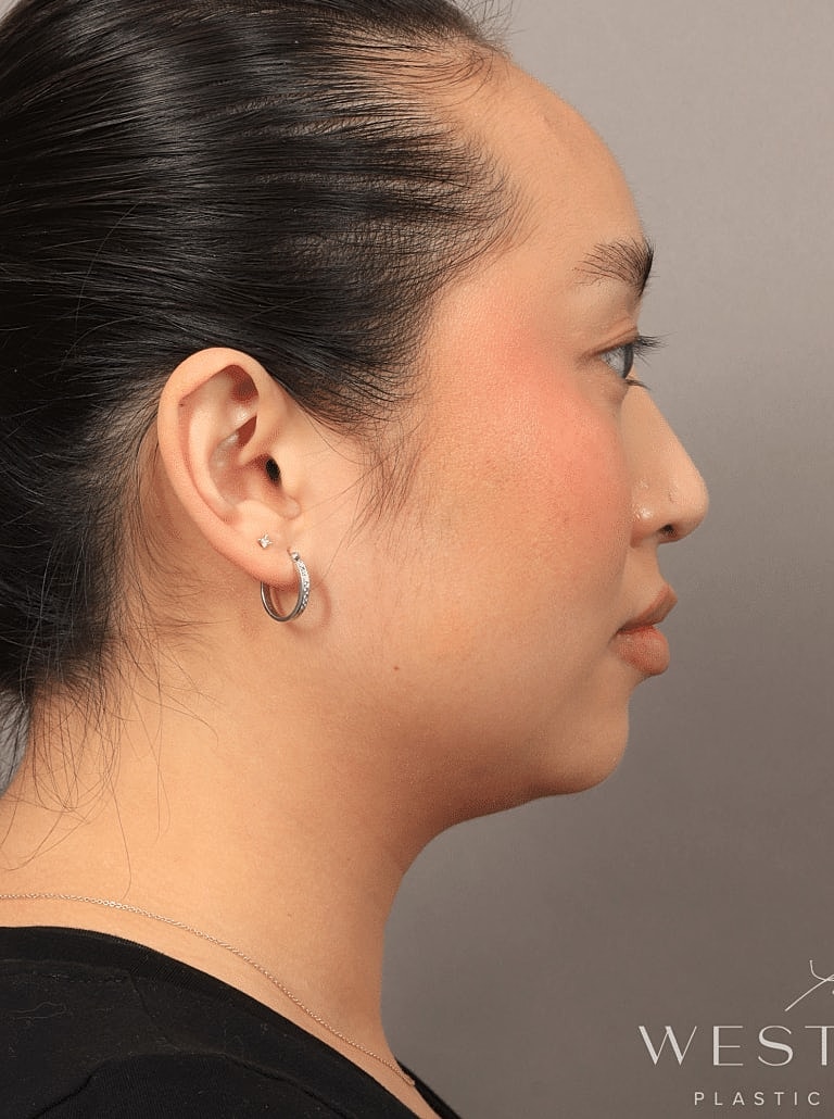 Nose Job Rhinoplasty Before & After
