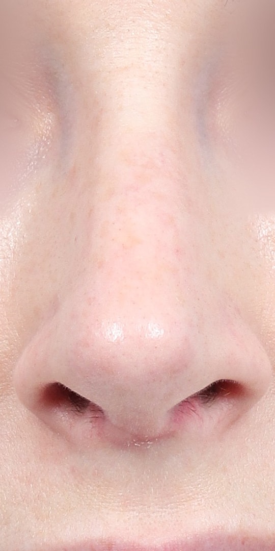 Nose Job Rhinoplasty Before & After