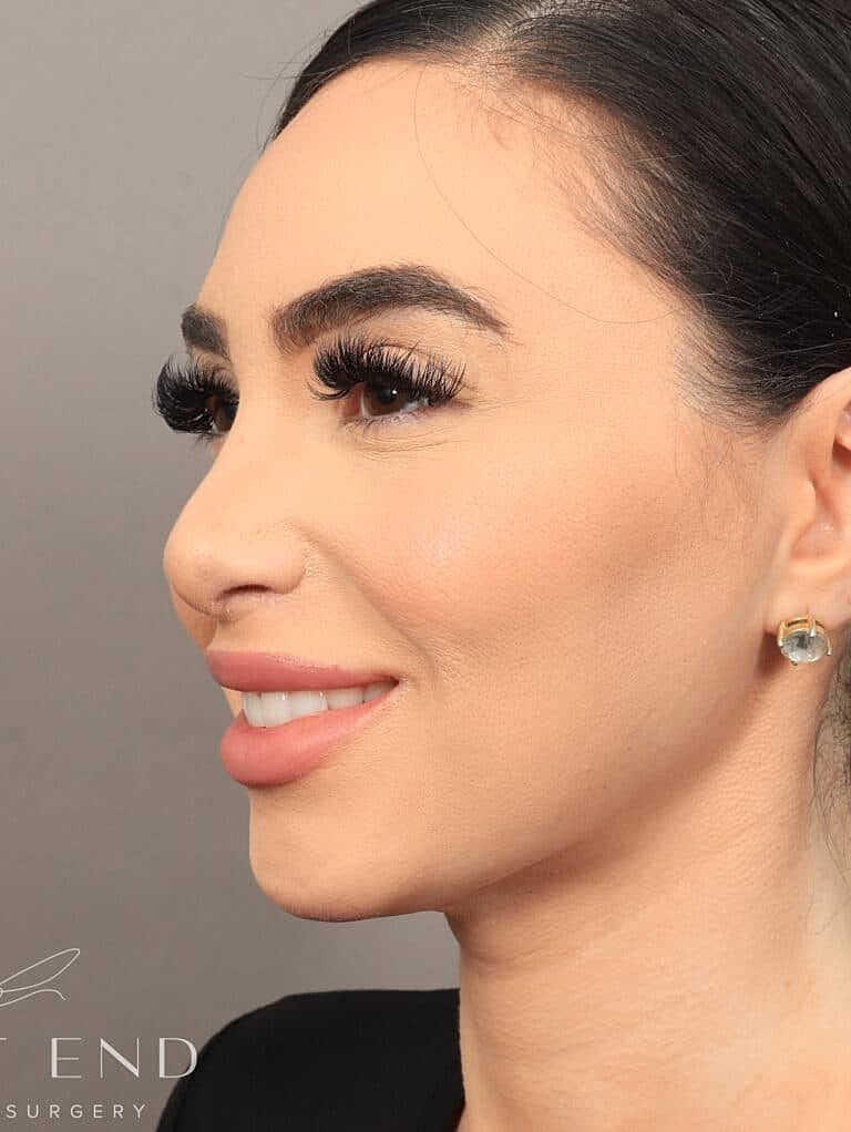 Nose Job Rhinoplasty Before & After