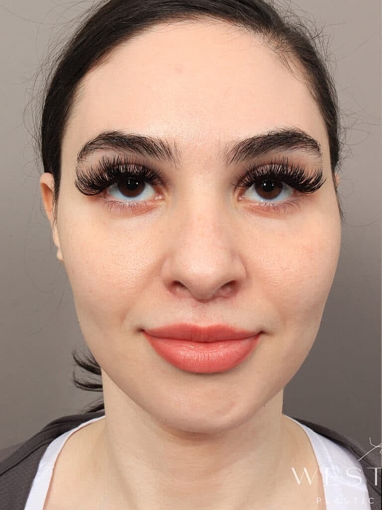 Nose Job Rhinoplasty Before & After