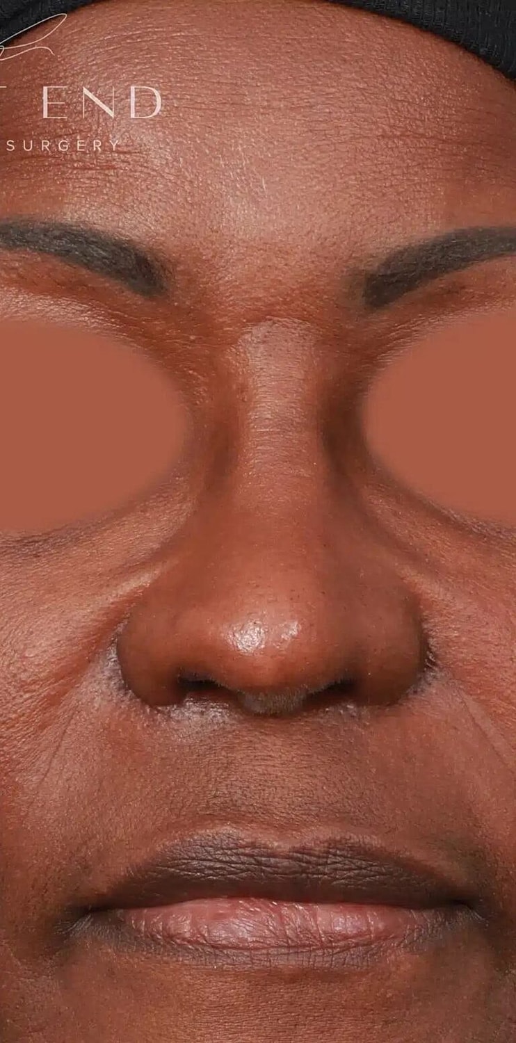 Nose Job Rhinoplasty Before & After