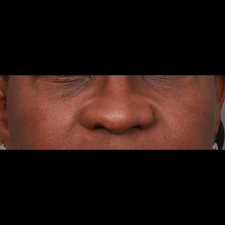 Nose Job Rhinoplasty Before & After