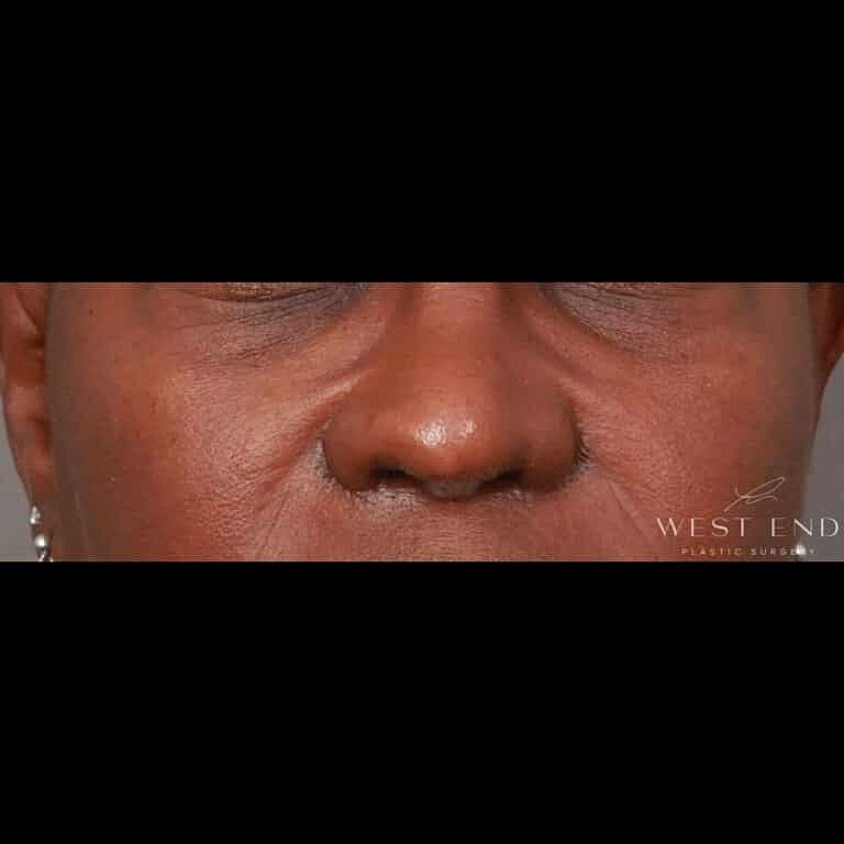 Nose Job Rhinoplasty Before & After