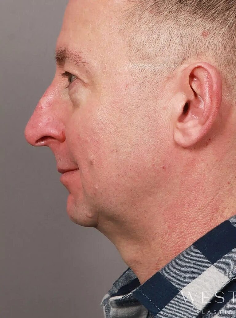 Nose Job Rhinoplasty Before & After