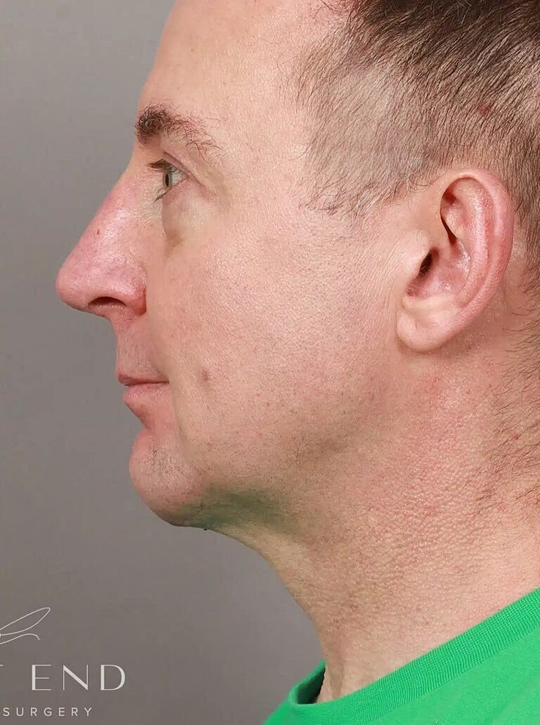 Nose Job Rhinoplasty Before & After