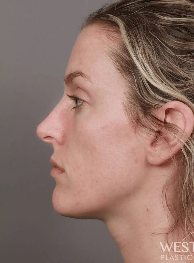 Nose Job Rhinoplasty Before & After