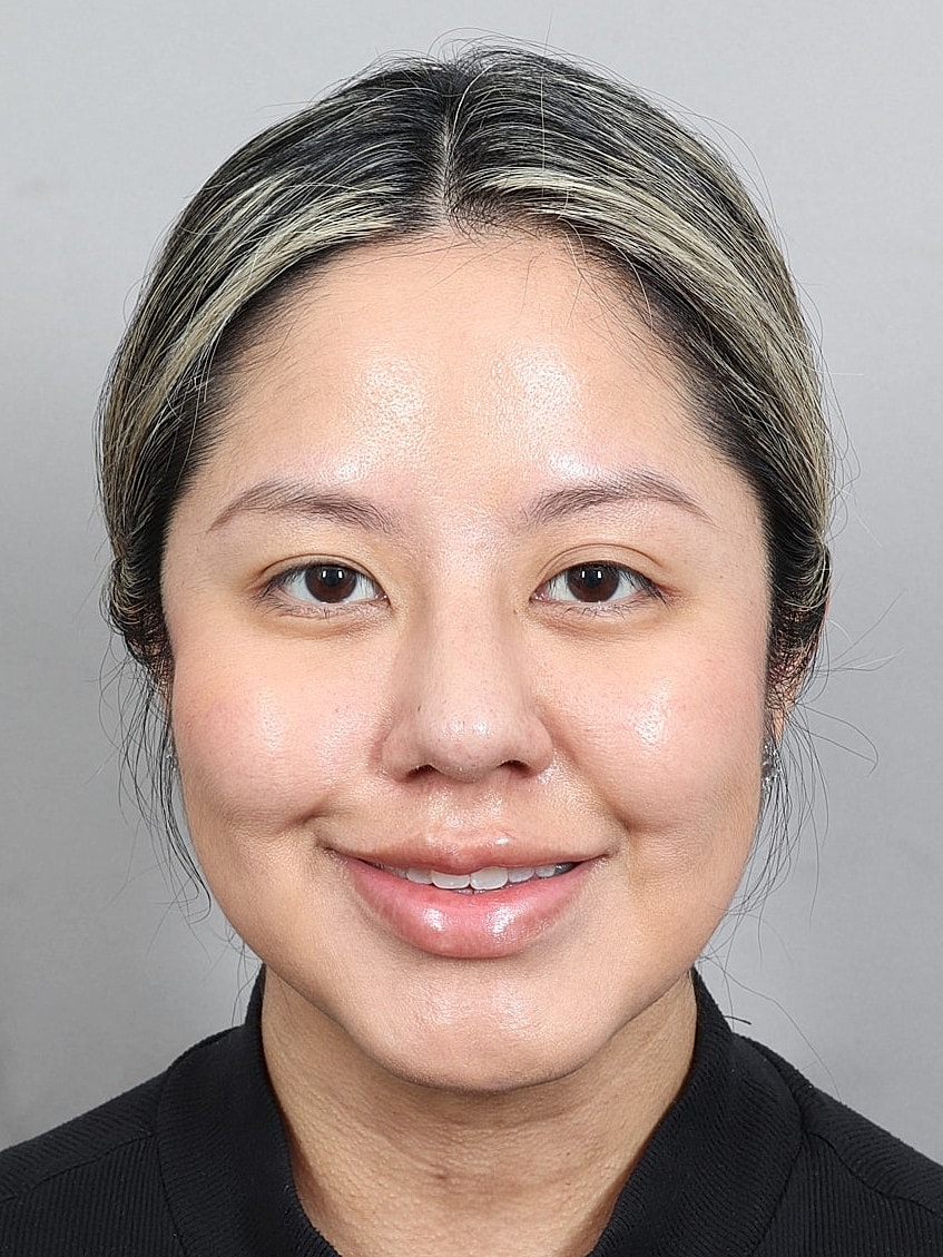 Nose Job Rhinoplasty Before & After