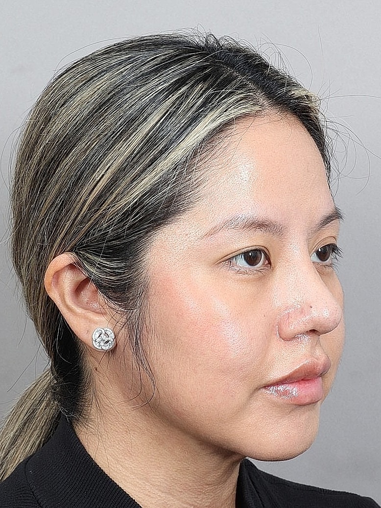 Nose Job Rhinoplasty Before & After