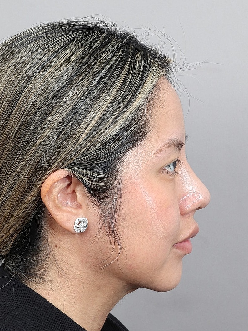 Nose Job Rhinoplasty Before & After
