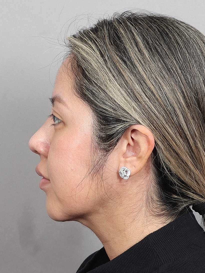 Nose Job Rhinoplasty Before & After