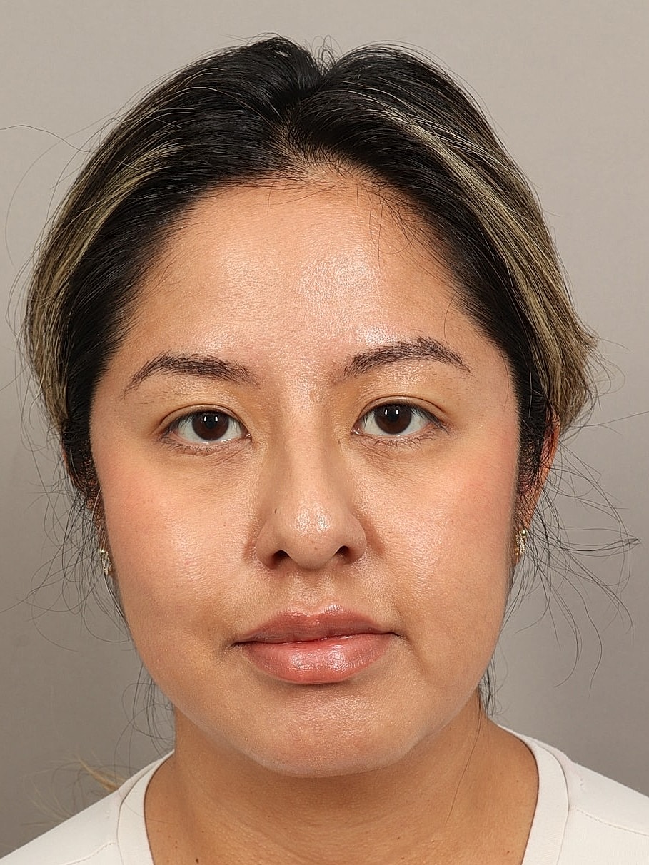 Chin Implant Before & After