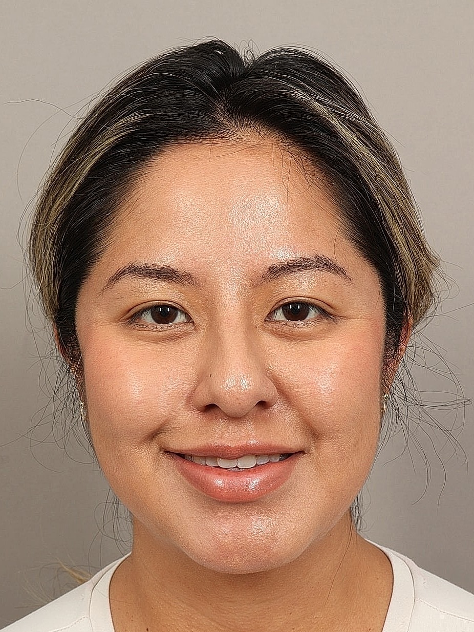 Nose Job Rhinoplasty Before & After