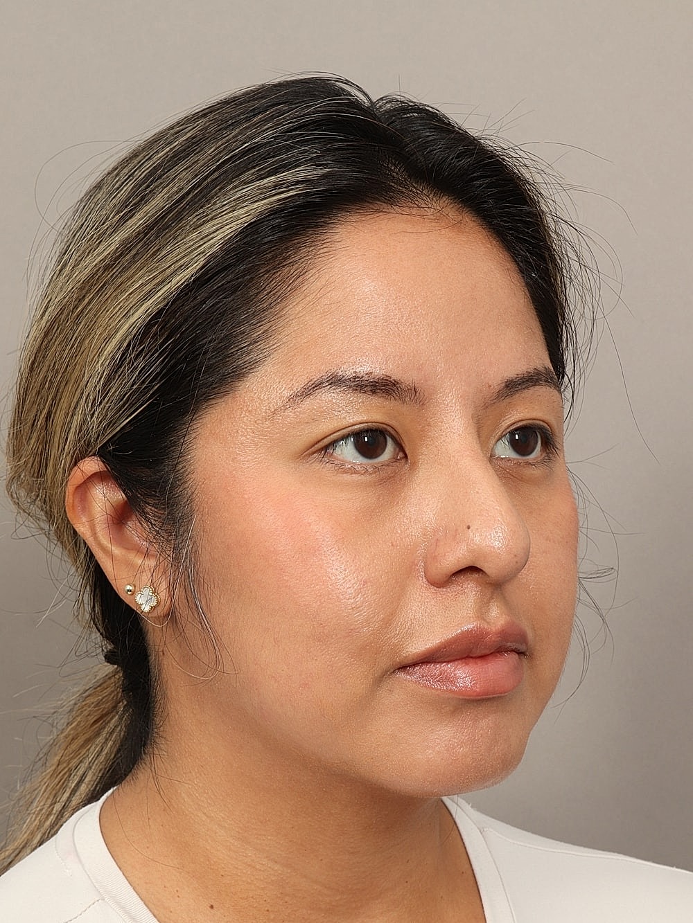 Nose Job Rhinoplasty Before & After