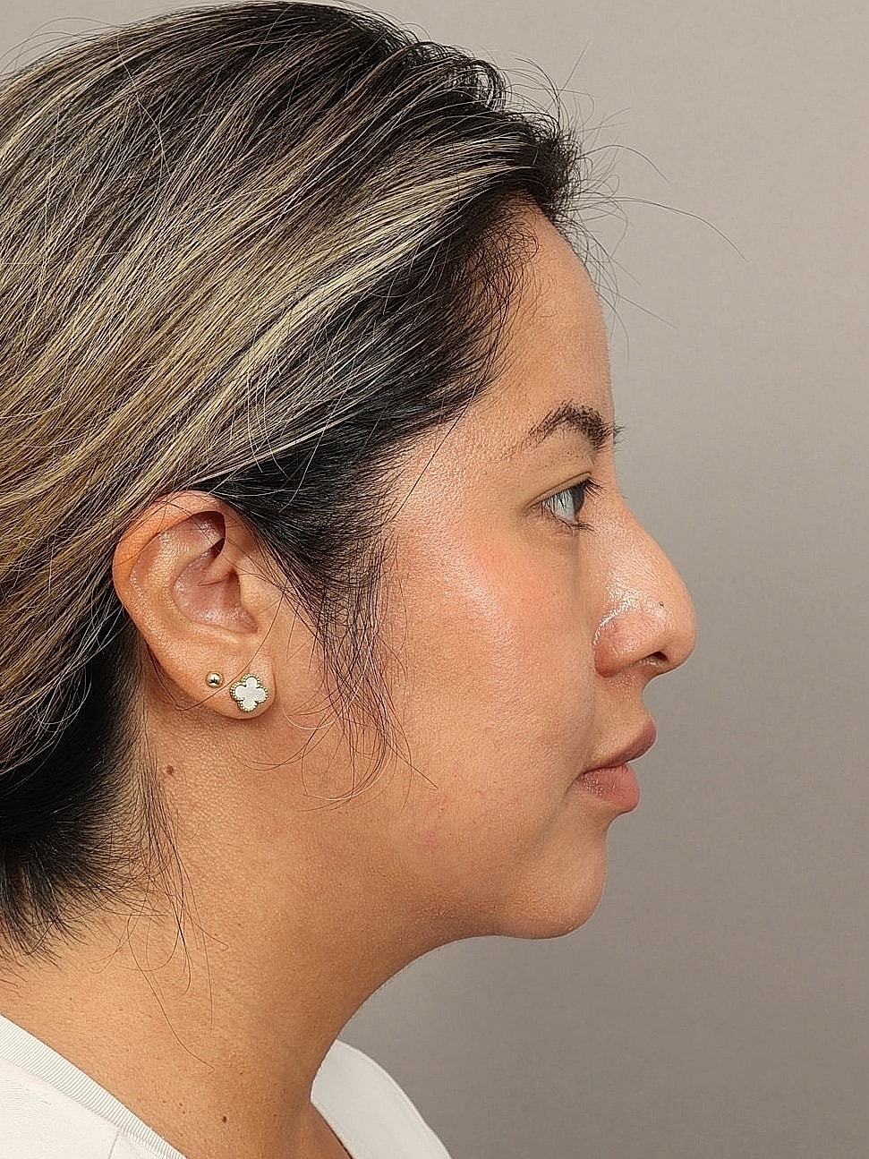 Nose Job Rhinoplasty Before & After