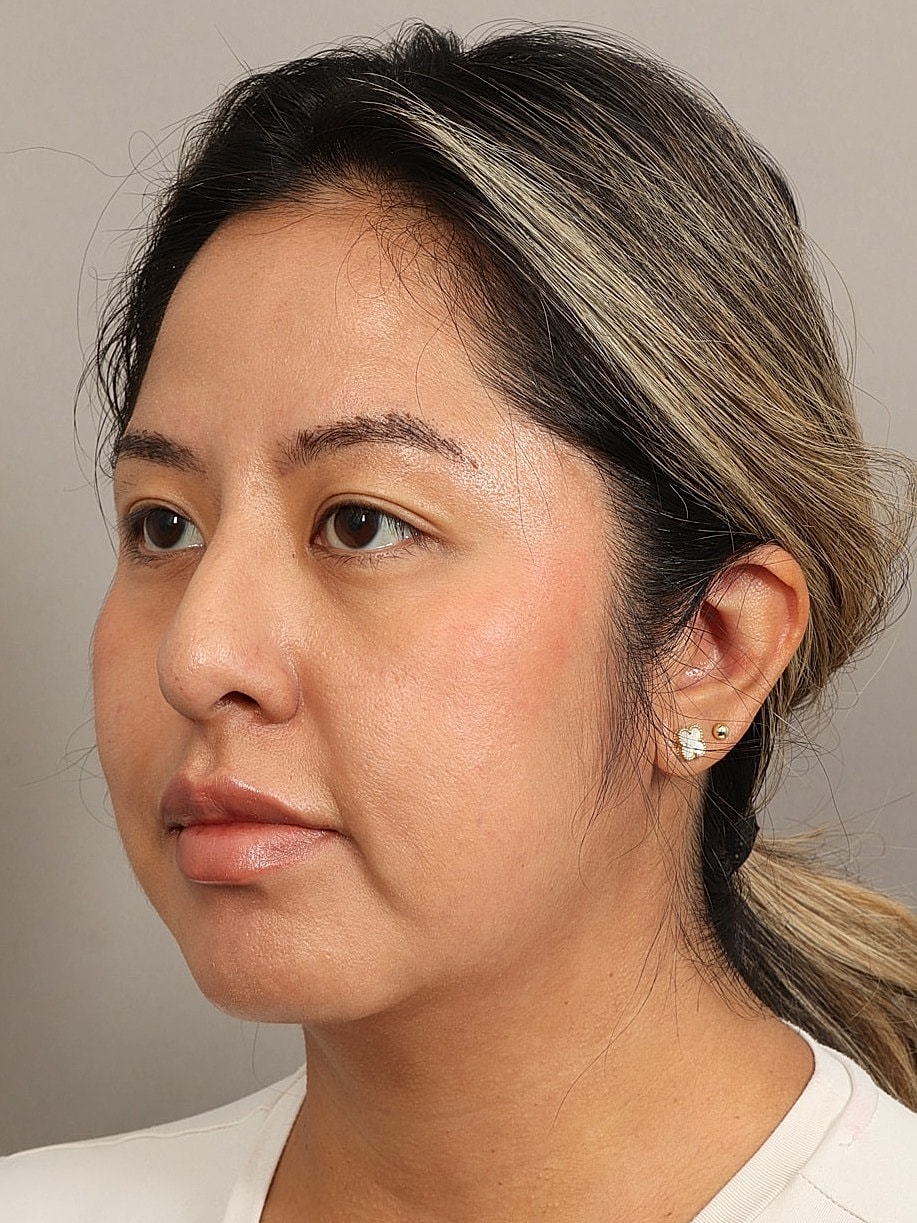 Nose Job Rhinoplasty Before & After
