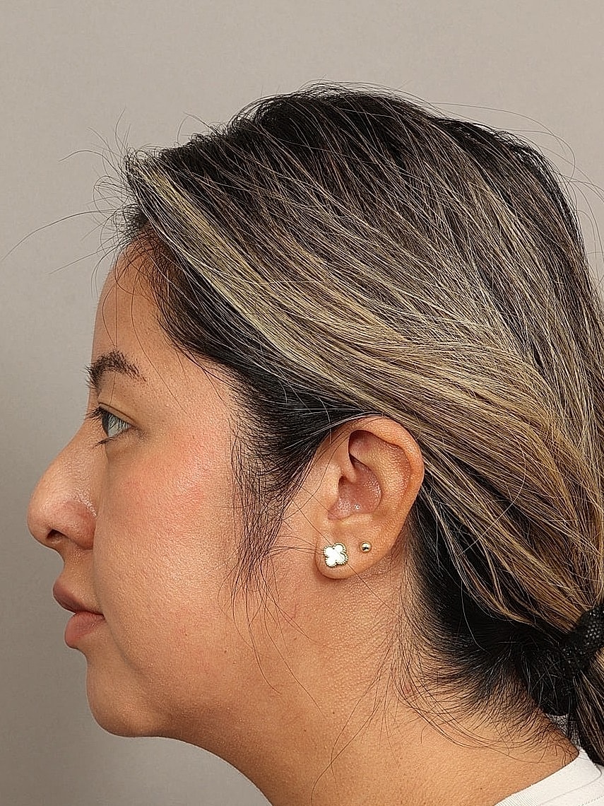 Nose Job Rhinoplasty Before & After