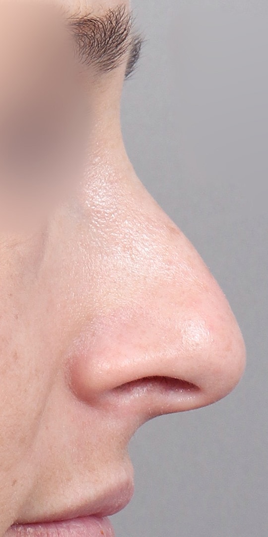 Nose Job Rhinoplasty Before & After