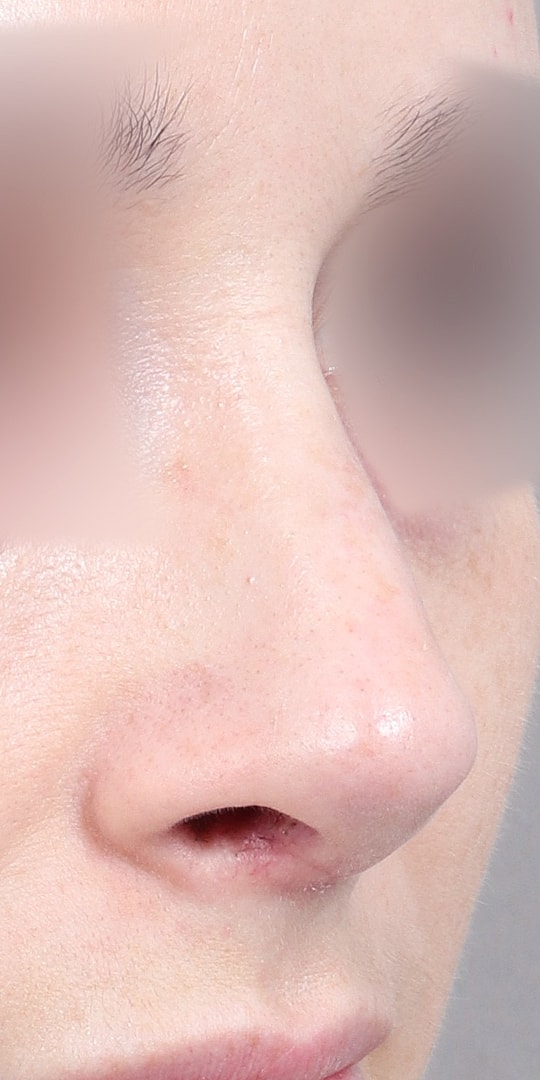 Nose Job Rhinoplasty Before & After