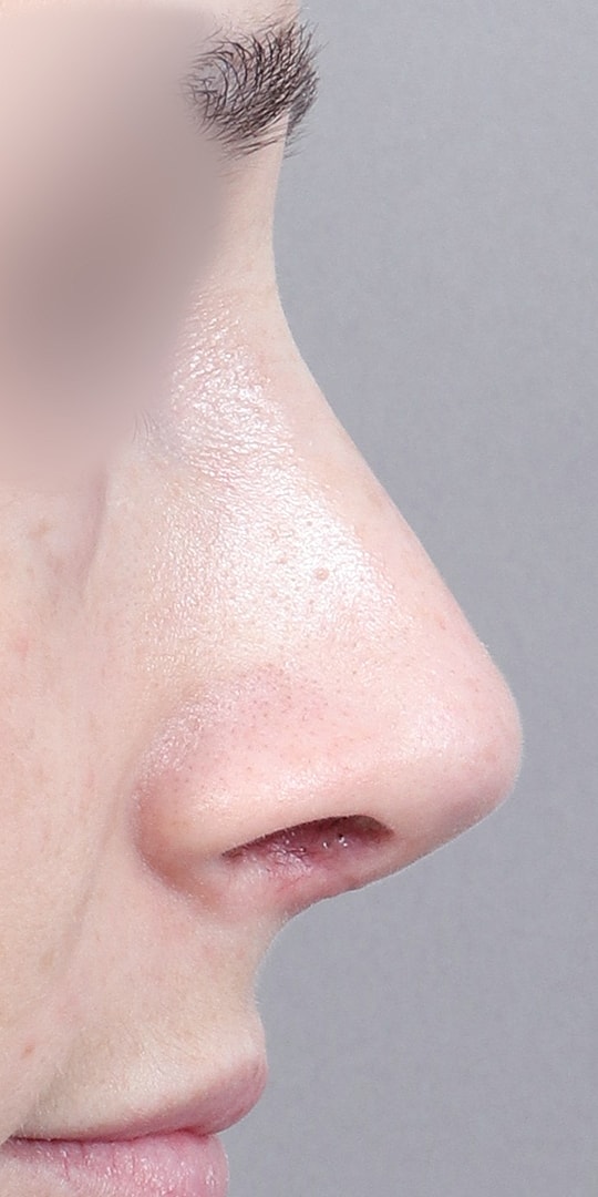 Nose Job Rhinoplasty Before & After