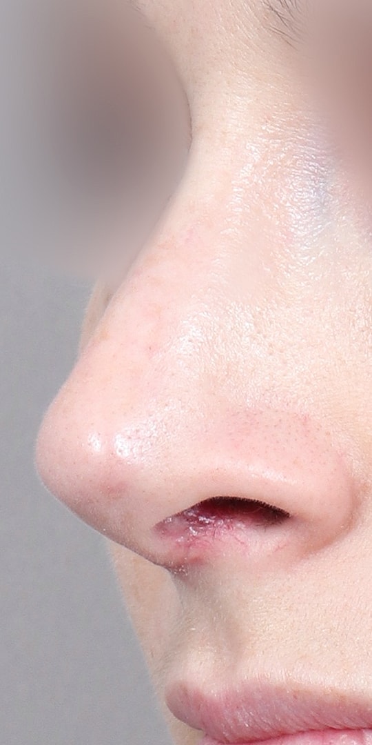 Nose Job Rhinoplasty Before & After