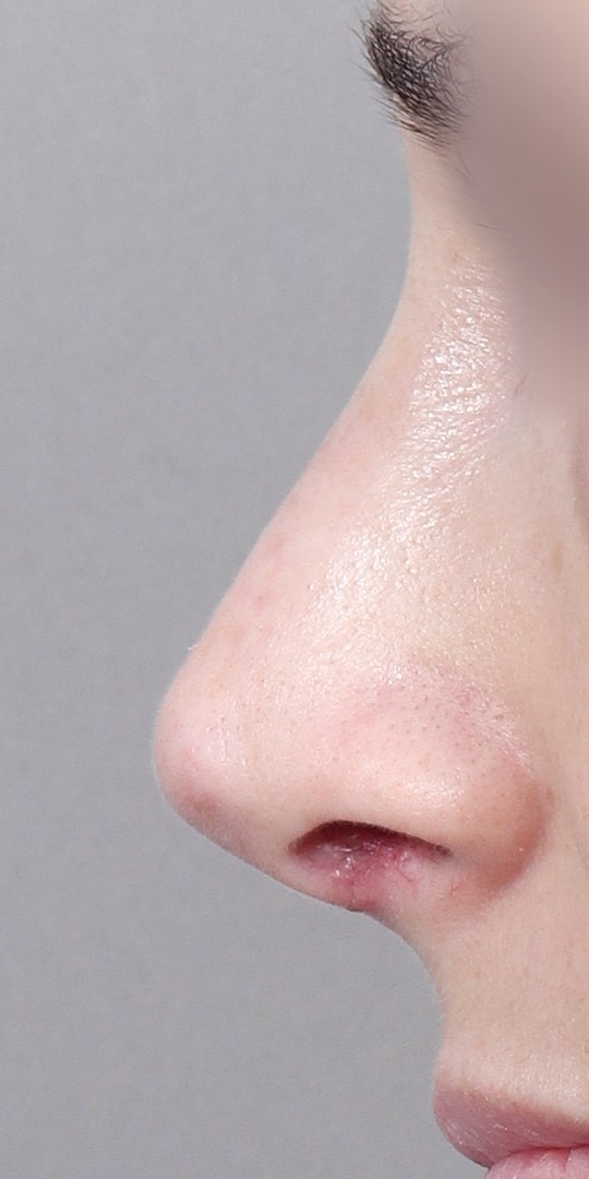 Nose Job Rhinoplasty Before & After