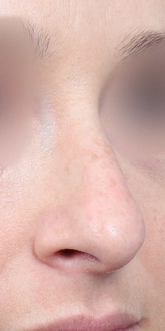 Nose Job Rhinoplasty Before & After