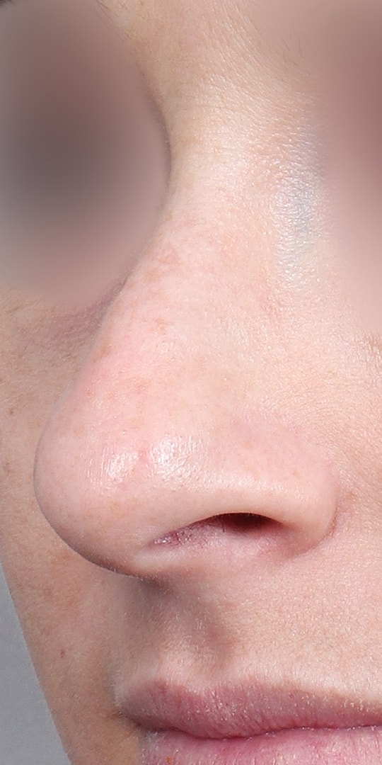 Nose Job Rhinoplasty Before & After