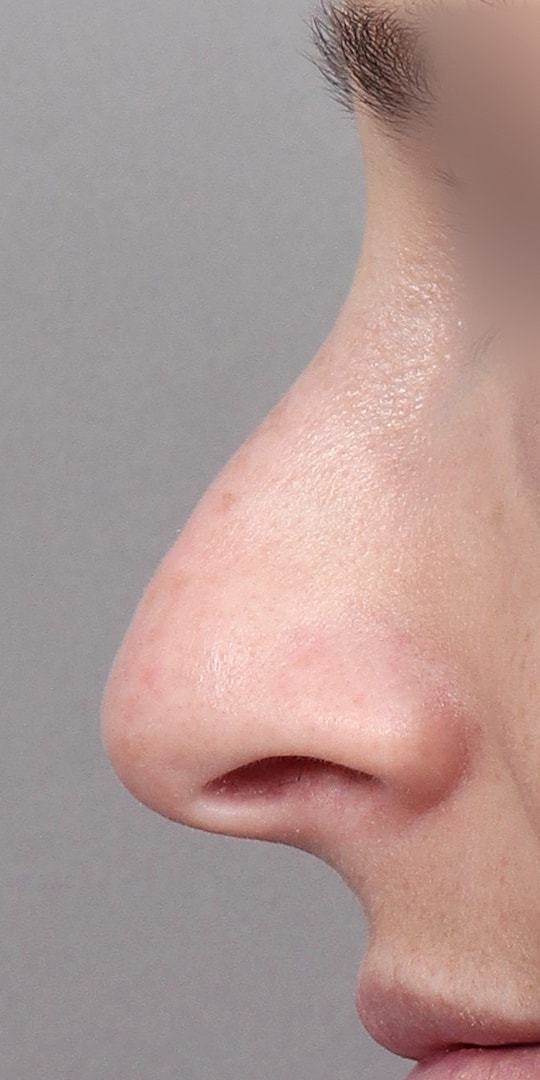 Nose Job Rhinoplasty Before & After
