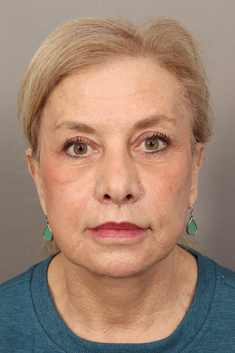 Blepharoplasty Before & After