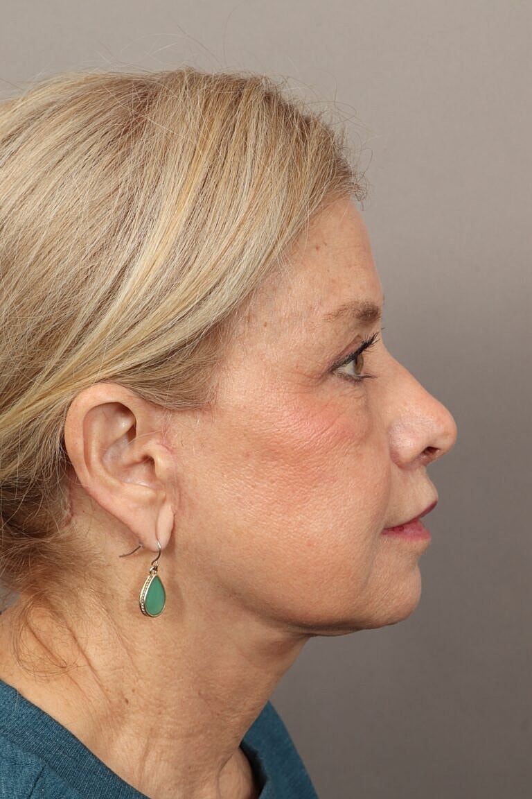Blepharoplasty Before & After