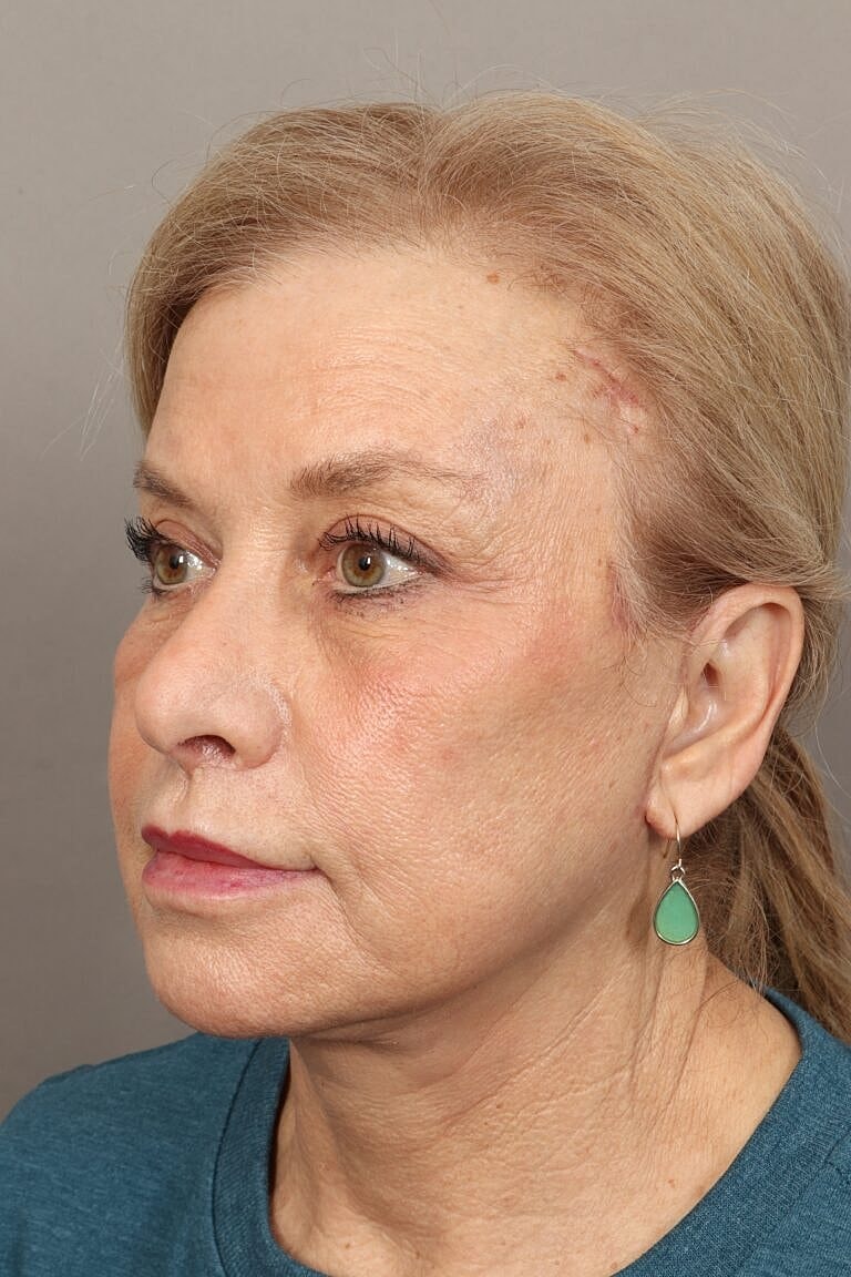 Blepharoplasty Before & After