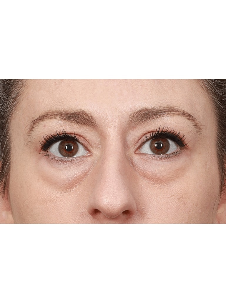 Blepharoplasty Before & After