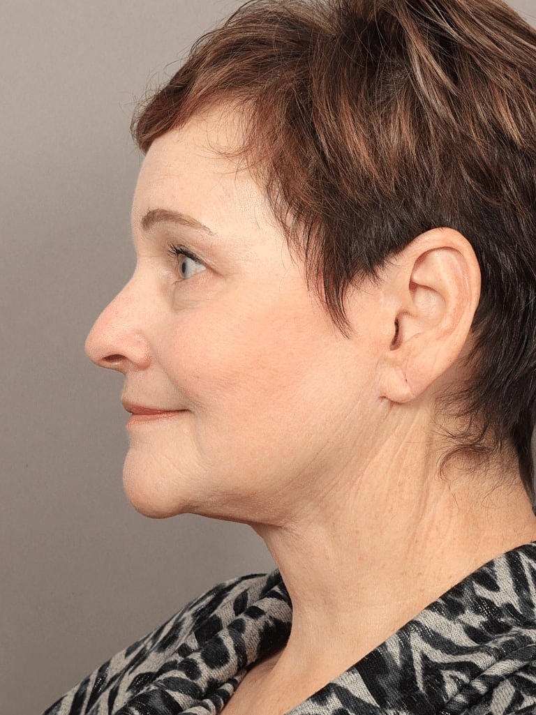 Blepharoplasty Before & After