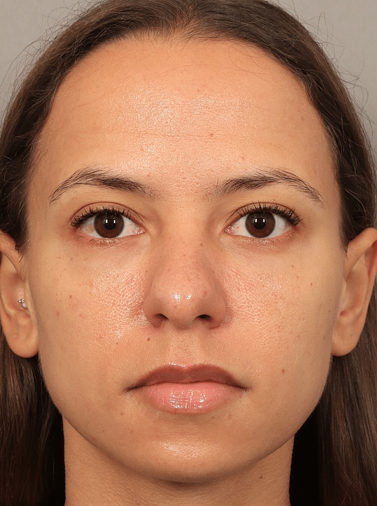 Blepharoplasty Before & After