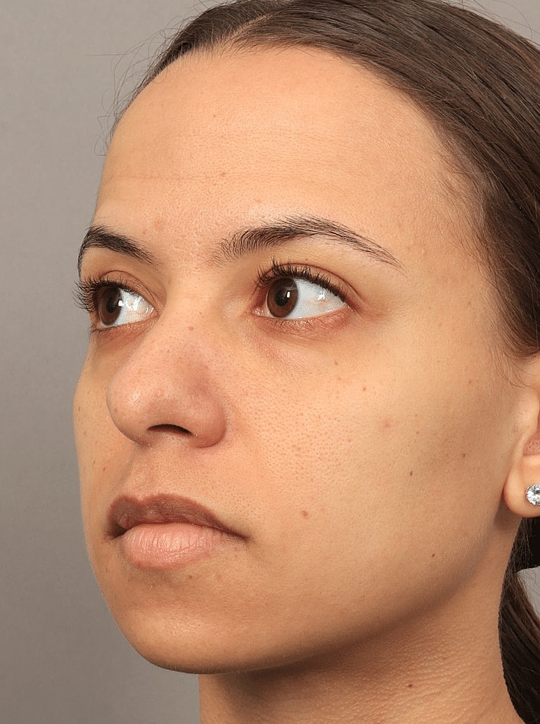 Blepharoplasty Before & After
