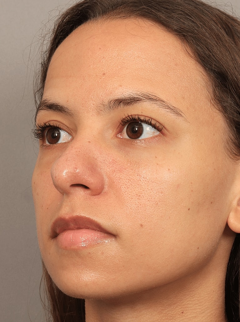Blepharoplasty Before & After