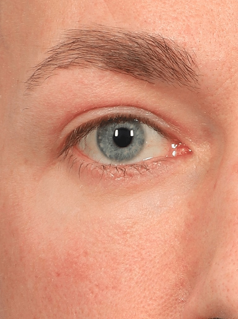 Blepharoplasty Before & After