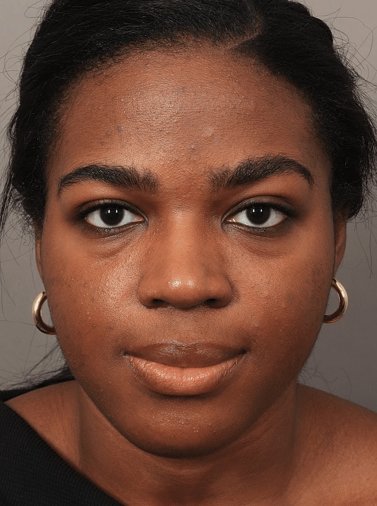 Blepharoplasty Before & After