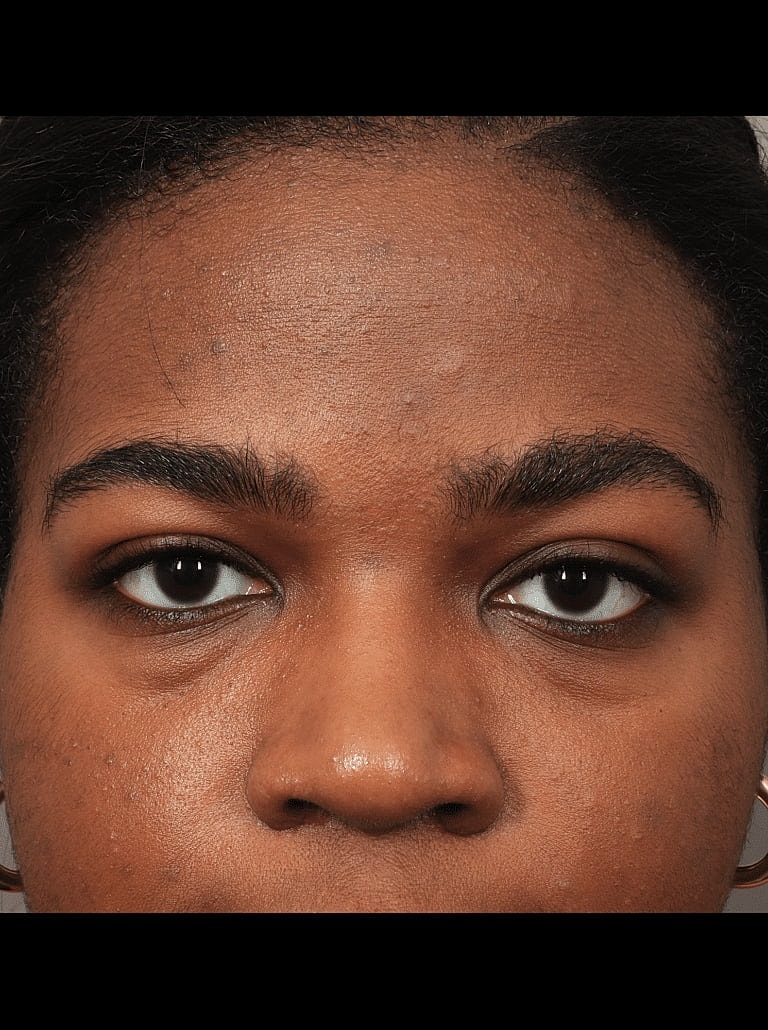 Blepharoplasty Before & After