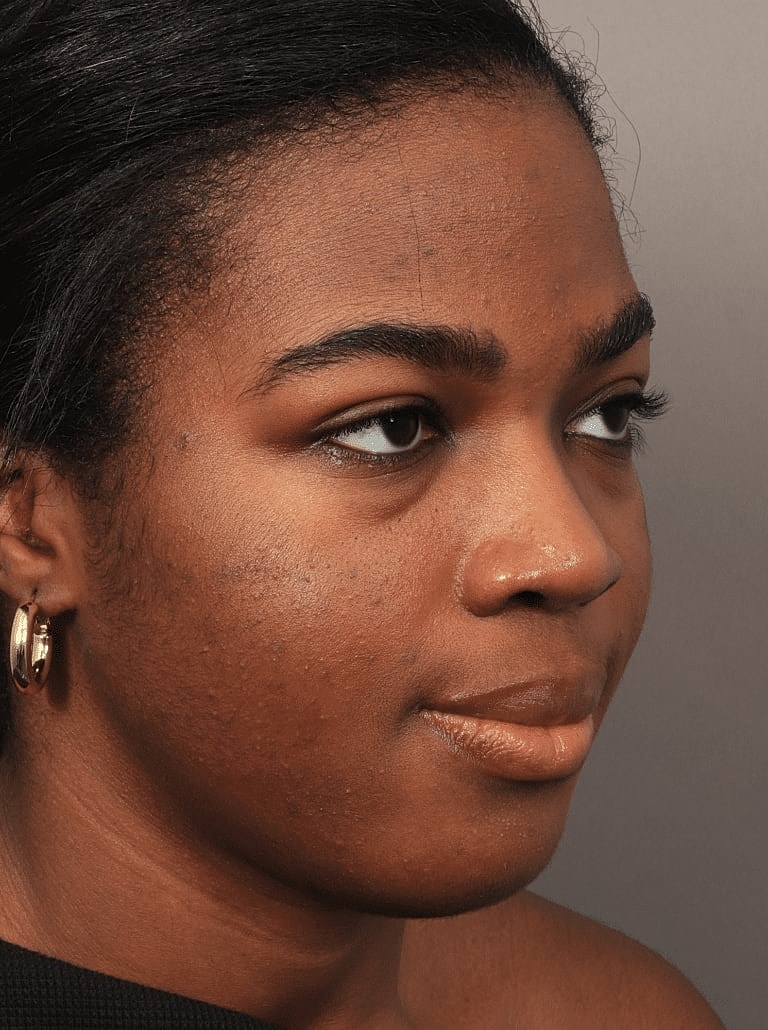 Blepharoplasty Before & After