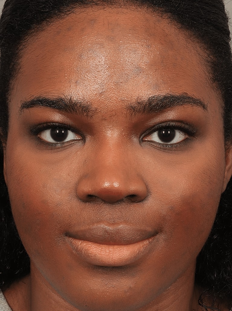 Blepharoplasty Before & After