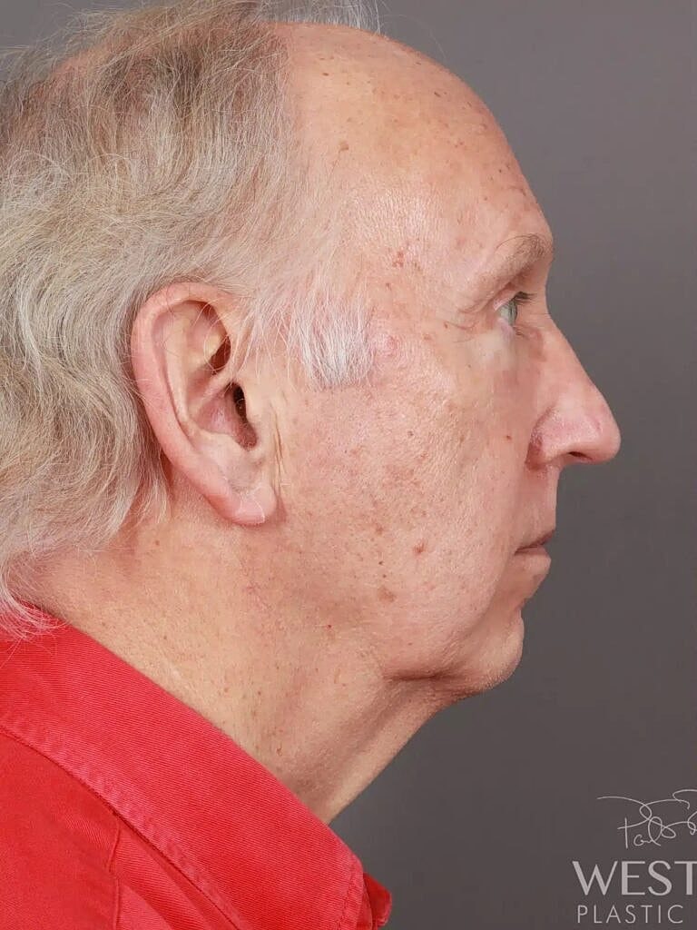 Blepharoplasty Before & After