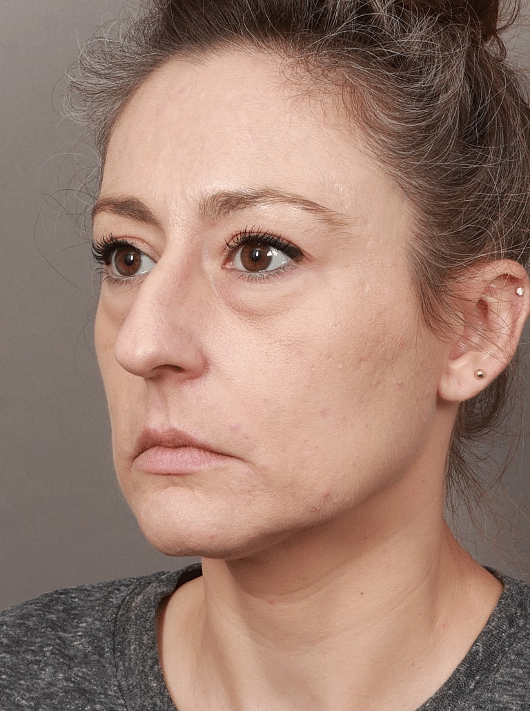 Blepharoplasty Before & After